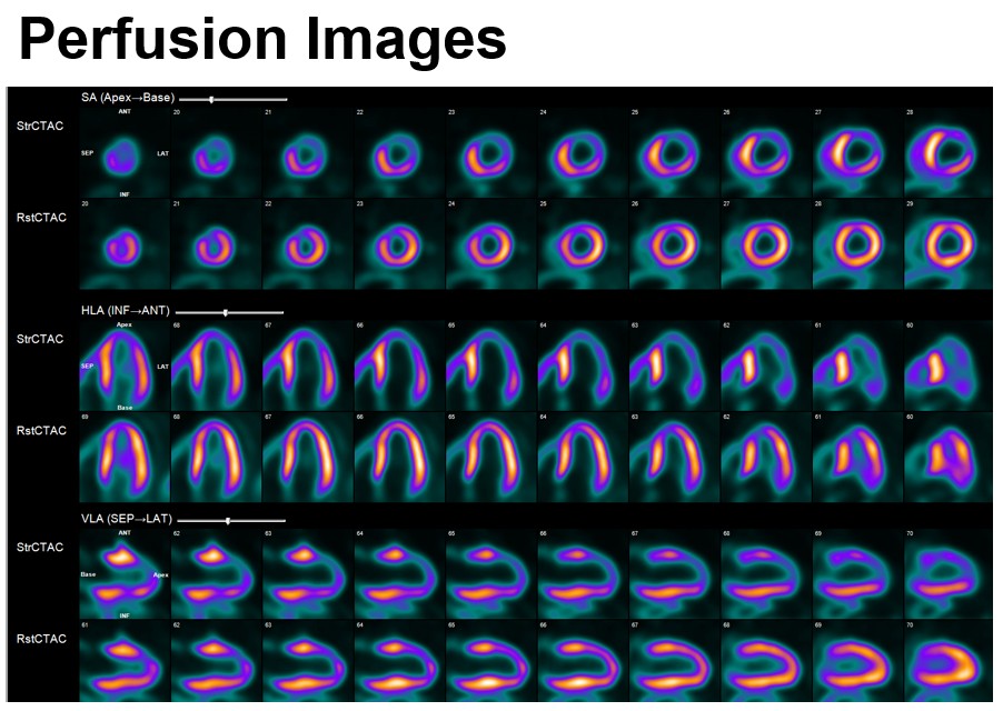 MyASNC's tweet image. New #CVNuc #ThinkPET case poll! 68-yr-old man with history of prior multivessel PCI undergoes regadenoson F-18 flurpiridaz PET MPI to evaluate refractory angina. What do the imaging findings show?  Vote below.