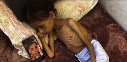 تخيّل أن طفلتك تتضور جوعًا أمام عينيك، يتقلص جسدها حتى يصبح هيكلًا عظميًا، تبكي بلا صوت، وتئن بلا قوة… هذا ليس خيالًا، بل حقيقة يعيشها أطفال غزة الآن تحت حصار قاتل وجوعٍ لا يرحم، والعالم يصمت.