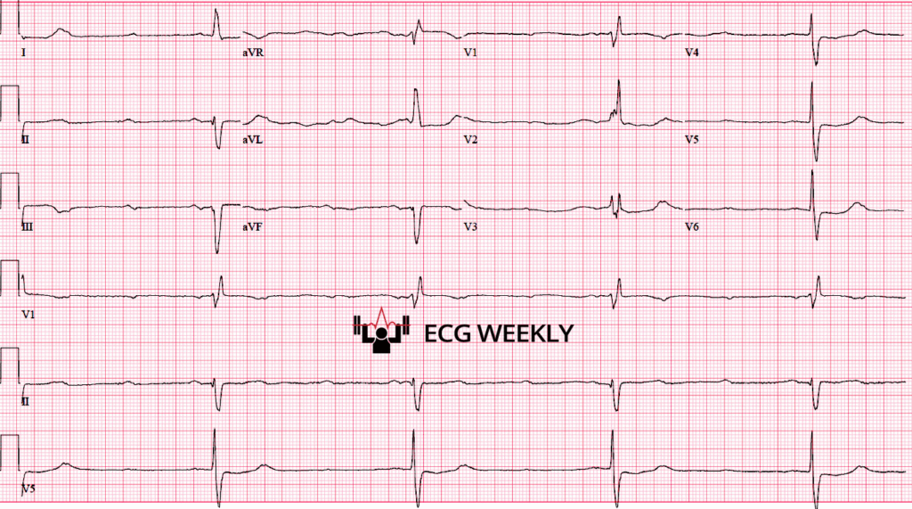 A 51-year-old man presents to the emergency department via EMS with nausea, vomiting, weakness, severe bradycardia (HR in the 20s), and hypotension (BP 60s systolic). The following ECG is obtained on arrival:ecgweekly.com/weekly-workout…