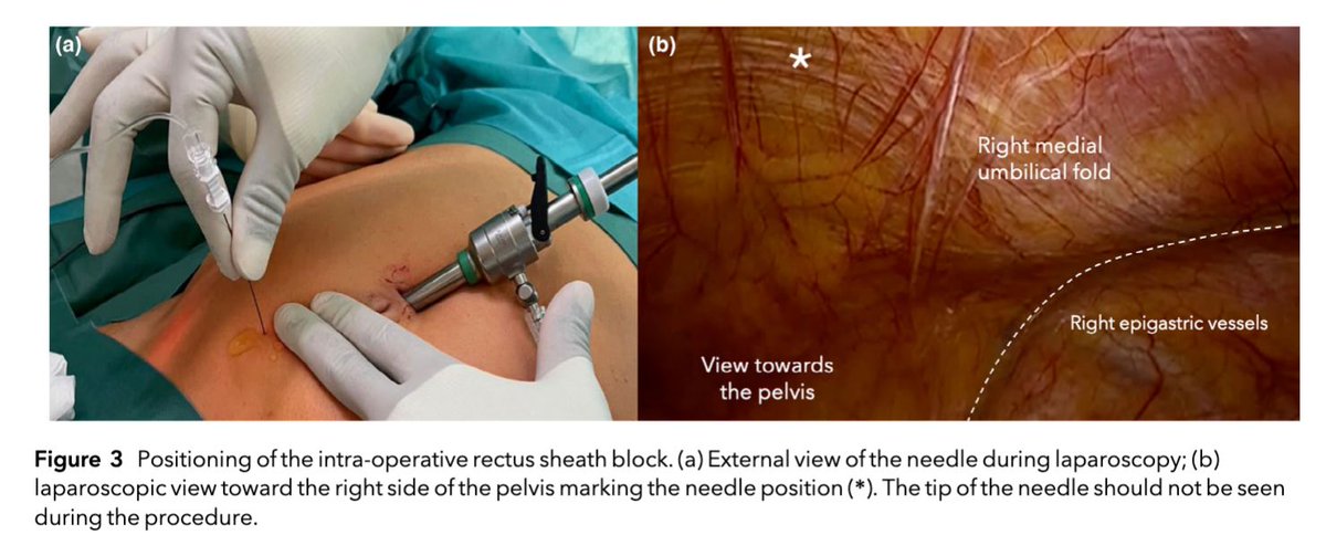 Anaes_Journal's tweet image. Laparoscopic rectus sheath blocks in inguinal hernia repair - yay or nay?

#anaesthesia #FreeForAWeek #regionalanaesthesia #regionalanesthesia #pain #surgery #MedTwitter

doi.org/10.1111/anae.1…