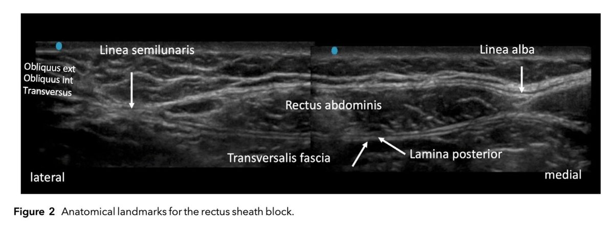 Anaes_Journal's tweet image. Laparoscopic rectus sheath blocks in inguinal hernia repair - yay or nay?

#anaesthesia #FreeForAWeek #regionalanaesthesia #regionalanesthesia #pain #surgery #MedTwitter

doi.org/10.1111/anae.1…