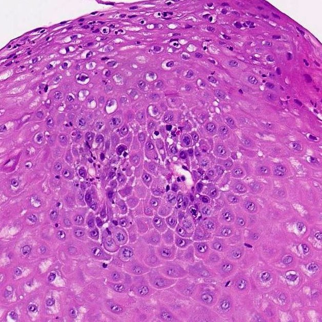 Yasamin Mirzabeigi, MD (@ymirzabeigi) on Twitter photo Happy Monday with this cutie! 🤩🤩 What catches your eye in this esophagus biopsy?
#PathX #GIPath <a href="/UMiamiPathology/">UMiami Pathology</a> Happy Monday with this cutie! 🤩🤩 What catches your eye in this esophagus biopsy?
#PathX #GIPath <a href="/UMiamiPathology/">UMiami Pathology</a>