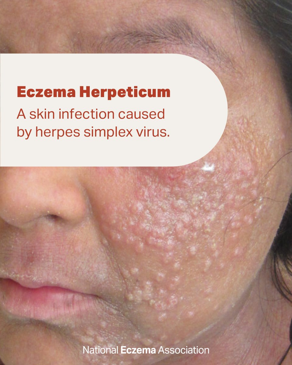 #EczemaHerpeticum is a potentially serious #SkinInfection caused by the #HerpesSimplexVirus. 
⁠🦠
We created the #AtopicDermatitis Visual Guide so you can see images of #eczema and its related conditions: nationaleczema.org/visual-guide/

#GetEczemaWise