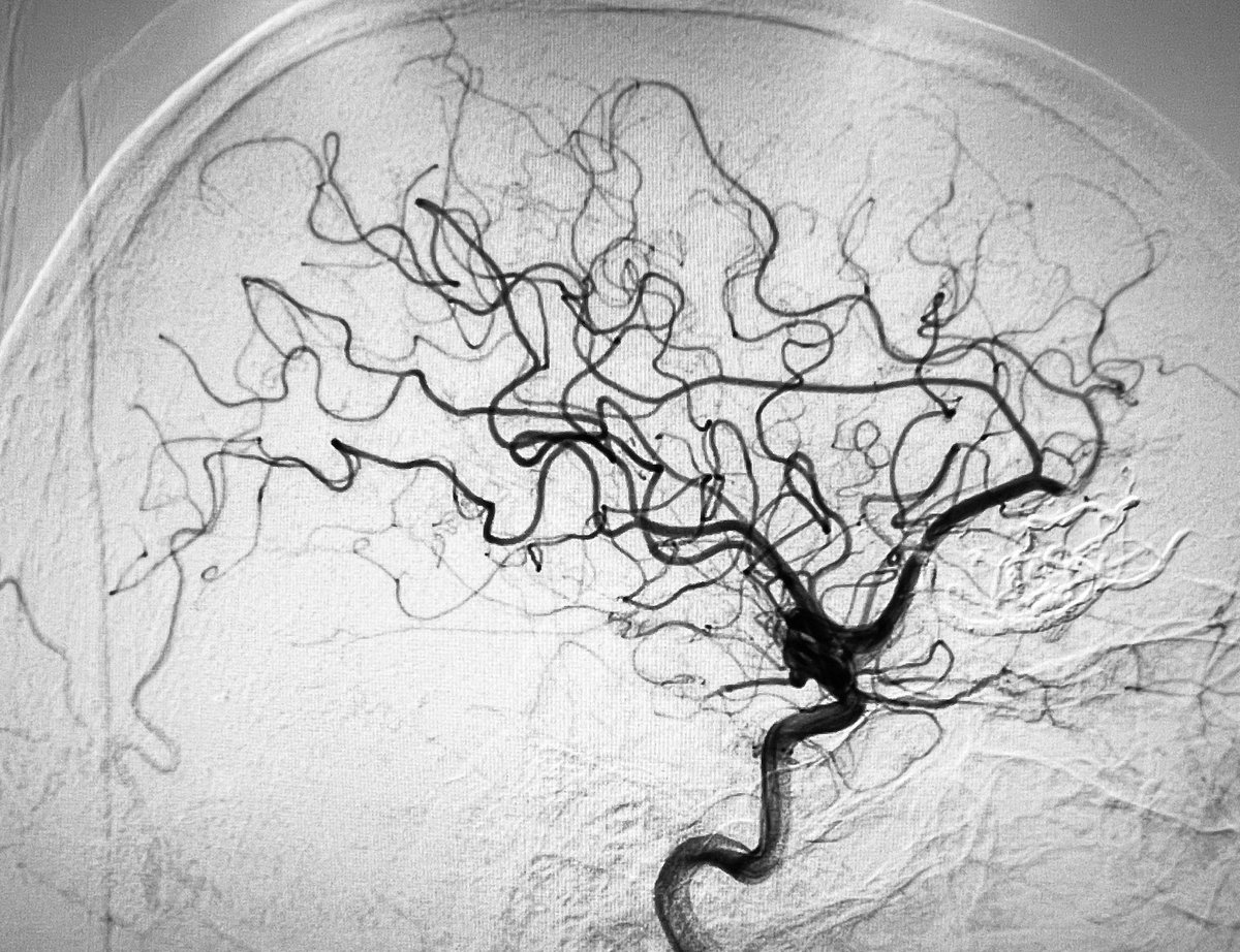One session – Triple simultaneous catheters – Complete bAVM obliteration!