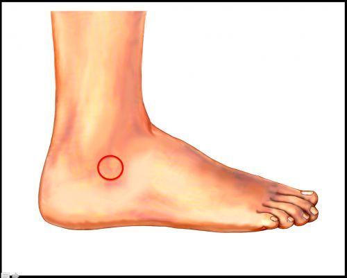 footEducation's tweet image. 🦶 Chronic lateral ankle pain? Consider Sinus Tarsi Syndrome.
👣 Associated with flat feet, prior sprains, or instability.
Treatment includes PT, orthotics, injections.
📚 buff.ly/QN9mUyV
#Orthopedics #AnklePain #AnkleInstability #SinusTarsi