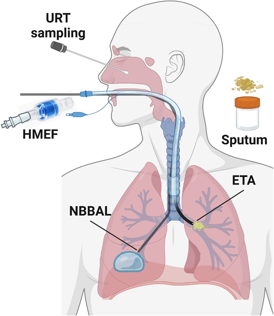 Mika Nonoyama (@mikarrt) on Twitter photo Worked on a report w/ a fab & diverse group from the <a href="/atscommunity/">American Thoracic Society (ATS)</a> on non-invasive upper respiratory tract sampling. Super interesting & research gap. Susan Toth & I...the only #RTs <a href="/SickkidsT/">SK Resp Therapy</a> <a href="/SickKidsNews/">The Hospital for Sick Children (SickKids)</a>. Thanks for #1 leadership & opp Dr. William Bain!
atsjournals.org/doi/full/10.15… Worked on a report w/ a fab & diverse group from the <a href="/atscommunity/">American Thoracic Society (ATS)</a> on non-invasive upper respiratory tract sampling. Super interesting & research gap. Susan Toth & I...the only #RTs <a href="/SickkidsT/">SK Resp Therapy</a> <a href="/SickKidsNews/">The Hospital for Sick Children (SickKids)</a>. Thanks for #1 leadership & opp Dr. William Bain!
atsjournals.org/doi/full/10.15…
