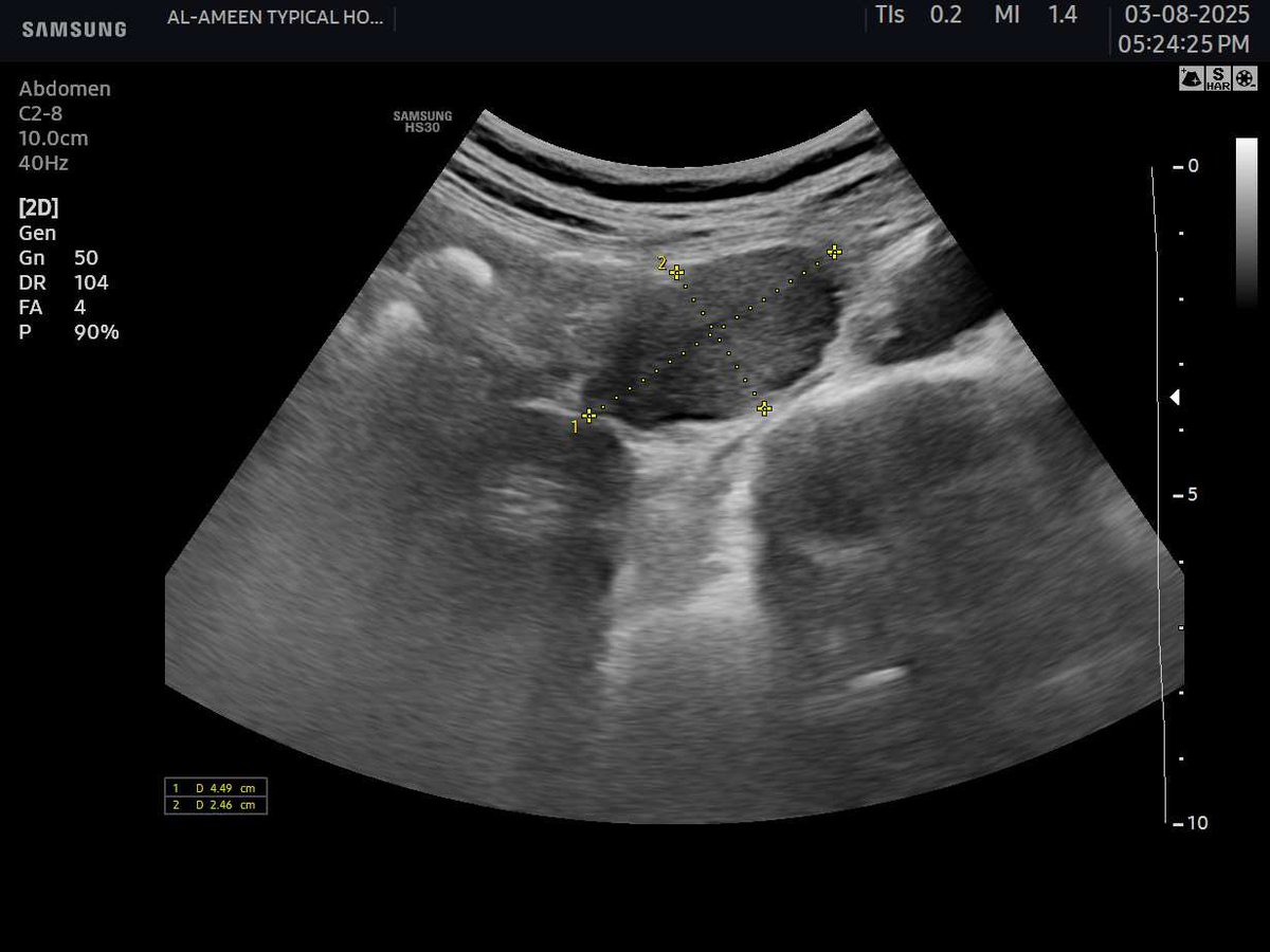 EchoTech_4's tweet image. 28 years female presented with non-specifc abdominal pain. 
This mass seen just posterior to the Stomach and left lateral to the abdominal aorta , your opinion?

#EchoTech
