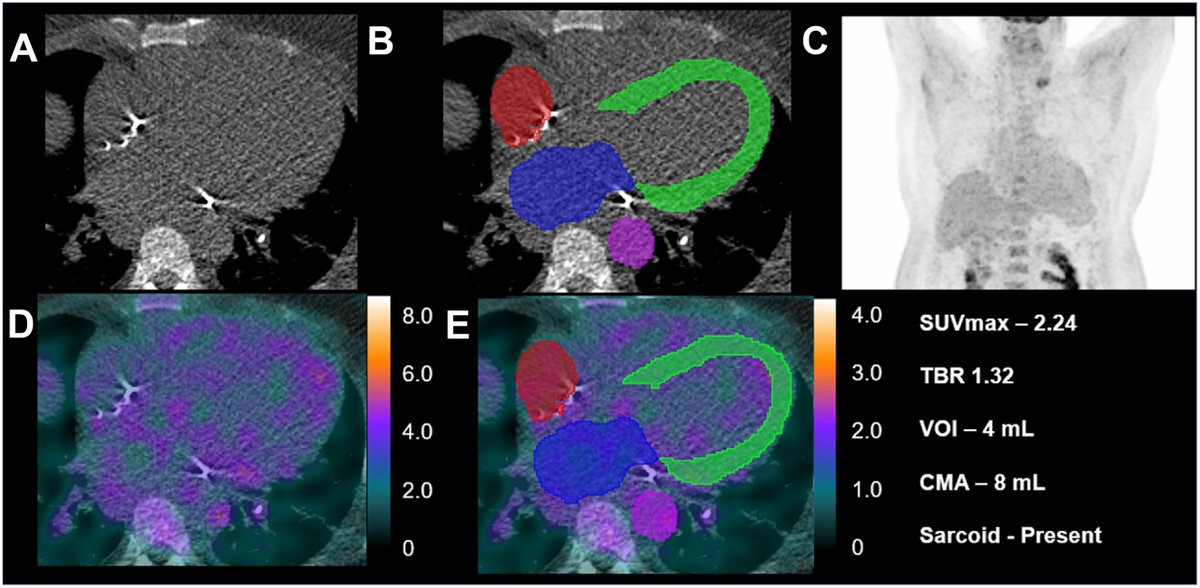 Journal of Nuclear Cardiology (@jncjournal) on Twitter photo Fully automated volumetric quantification of FDG PET for cardiac sarcoidosis based on CT attenuation map-derived volumetry is feasible, rapid, & has high prediction performance. <a href="/robertjhmiller/">Robert Miller</a> <a href="/UCalgary/">U Calgary</a> <a href="/Piotr_JSlomka/">Piotr Slomka PhD</a> <a href="/SmidtHeart/">Smidt Heart Institute at Cedars-Sinai</a>
Editorial by Osamu Manabe @ Jichi Medical Fully automated volumetric quantification of FDG PET for cardiac sarcoidosis based on CT attenuation map-derived volumetry is feasible, rapid, & has high prediction performance. <a href="/robertjhmiller/">Robert Miller</a> <a href="/UCalgary/">U Calgary</a> <a href="/Piotr_JSlomka/">Piotr Slomka PhD</a> <a href="/SmidtHeart/">Smidt Heart Institute at Cedars-Sinai</a>
Editorial by Osamu Manabe @ Jichi Medical