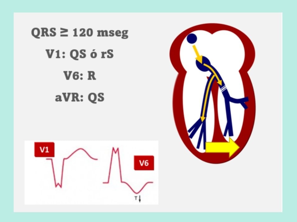 ZHeart11768530's tweet image. 🔴Bundle Branch Block Cheat Sheet⤵️🔹

 ️  #ekg #ECG
 #medtwitterWhat #MedTwitter #CardioEd #medx #medEd #CardioTwitter #cardiotwitter #MedX #MedEd #cardiology #cardiotwiteros #FOAMed #medicine #cardiox #medical #cardiovascular #medtwitter #medtwitter #paramedic