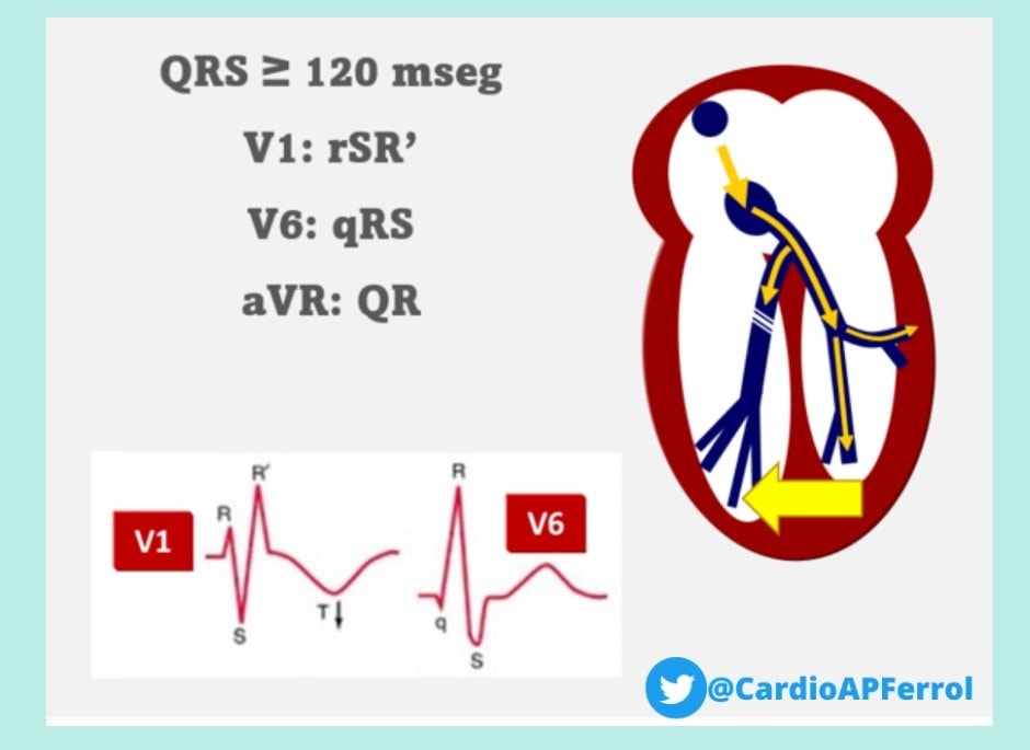 ZHeart11768530's tweet image. 🔴Bundle Branch Block Cheat Sheet⤵️🔹

 ️  #ekg #ECG
 #medtwitterWhat #MedTwitter #CardioEd #medx #medEd #CardioTwitter #cardiotwitter #MedX #MedEd #cardiology #cardiotwiteros #FOAMed #medicine #cardiox #medical #cardiovascular #medtwitter #medtwitter #paramedic