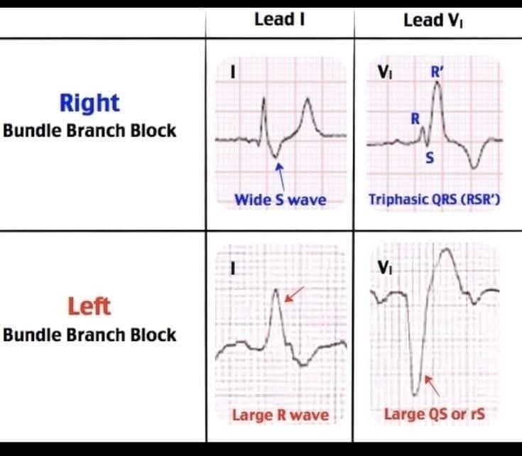 ZHeart11768530's tweet image. 🔴Bundle Branch Block Cheat Sheet⤵️🔹

 ️  #ekg #ECG
 #medtwitterWhat #MedTwitter #CardioEd #medx #medEd #CardioTwitter #cardiotwitter #MedX #MedEd #cardiology #cardiotwiteros #FOAMed #medicine #cardiox #medical #cardiovascular #medtwitter #medtwitter #paramedic