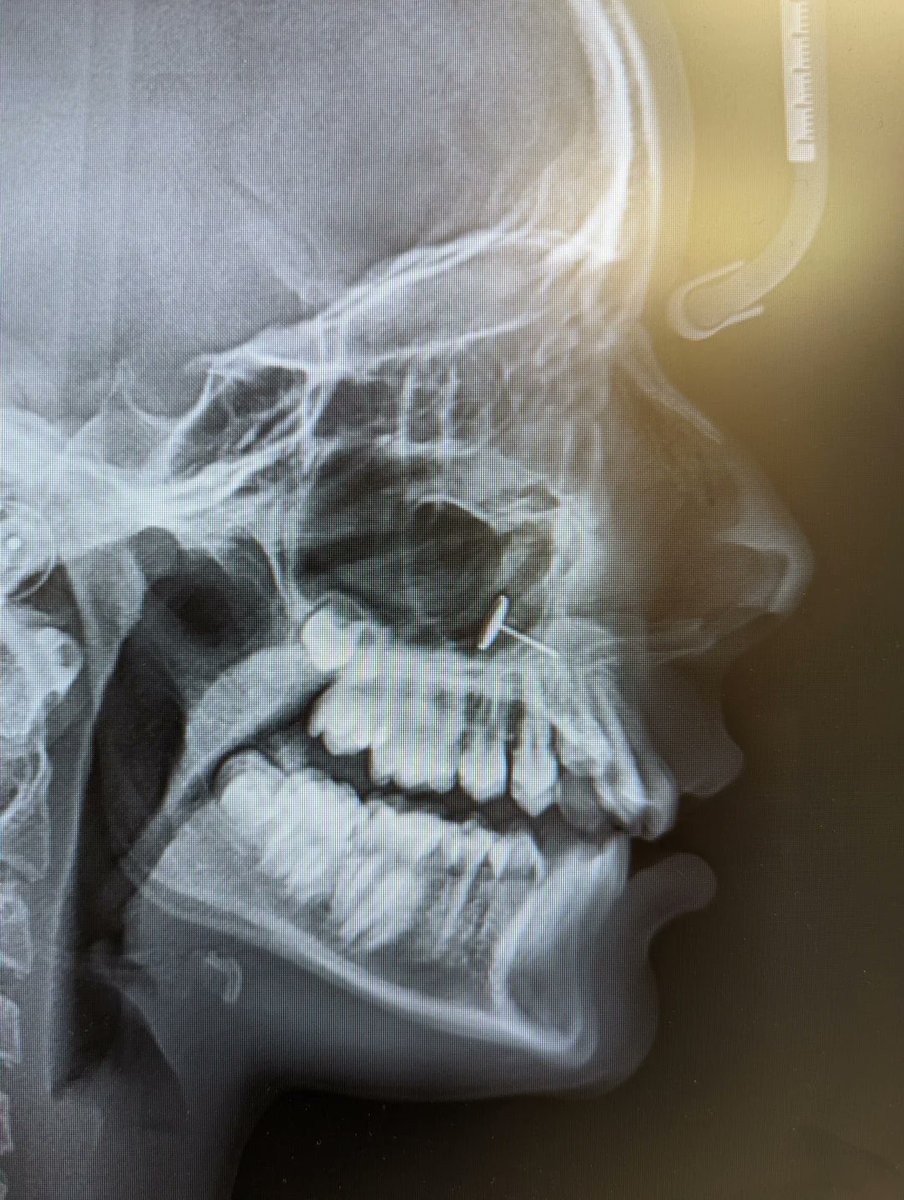 Kid tried to pierce her own nose and ended up inhaling an earring in the process..