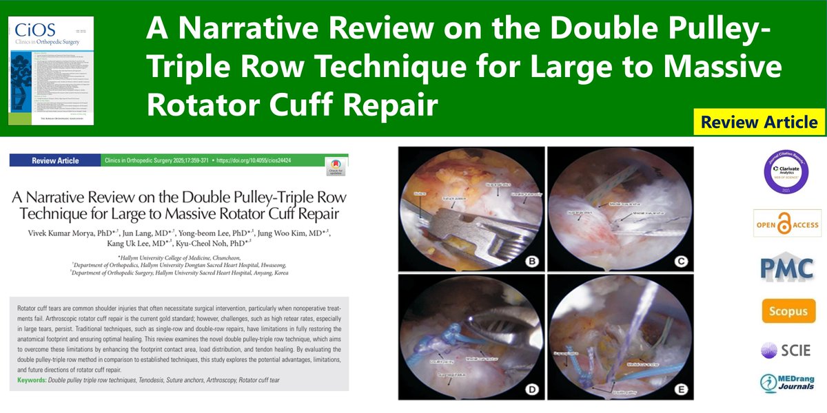 CiOSjournal's tweet image. A Narrative Review on the Double Pulley-Triple Row Technique for Large to Massive Rotator Cuff Repair
🌷doi.org/10.4055/cios24…
Clin Orthop Surg. 2025 Jun;17(3)Vivek Kumar Morya
#Double_pulley_triple_row_techniques #Tenodesis #Suture_anchors #Arthroscopy #Rotator_cuff_tear