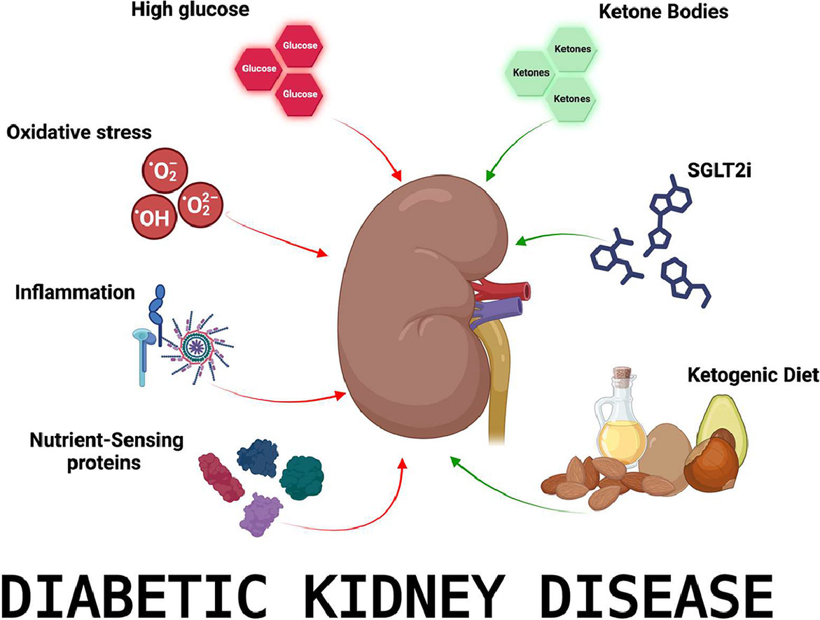 Ketone bodies in renal function and diabetic kidney disease doi.org/10.1016/j.jnut… #diabetes #diabetickidneydisease #renalhealth #kidneyfunction #ketonebodies #ketones #betahydroxybutyrate #ketogenicdiet #SGLT2inhibitors #oxidativestress