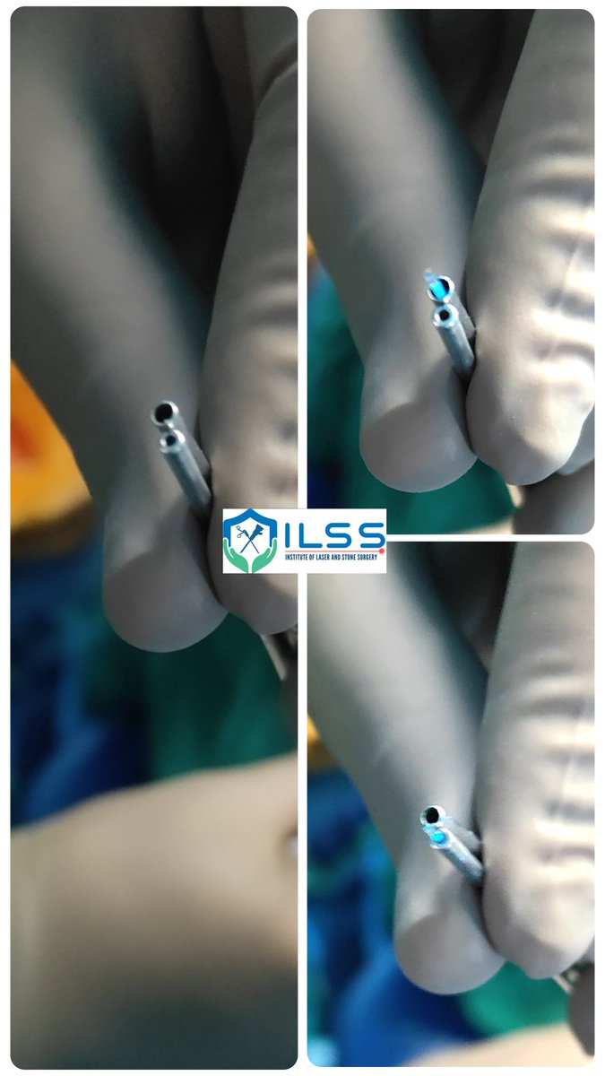 Wobbly fibre = wobbly outcome. Pick the perfect guide for a perfect pulse. #HoLEP #LaserSurgery #UroTips #ILSS