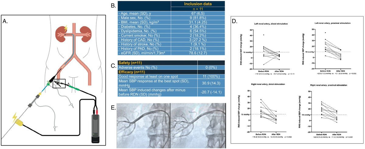 CRMjournal (@crmjournal) on Twitter photo Just accepted in <a href="/CRMjournal/">CRMjournal</a>+@ELS_Cardiology!
Feasibility and safety of #Renal nerve stimulation using the direct wire pacing (DWP®) technique during renal #Denervation procedure: A first-in-human study by Romain Boulestreau et al.
sciencedirect.com/science/articl… Just accepted in <a href="/CRMjournal/">CRMjournal</a>+@ELS_Cardiology!
Feasibility and safety of #Renal nerve stimulation using the direct wire pacing (DWP®) technique during renal #Denervation procedure: A first-in-human study by Romain Boulestreau et al.
sciencedirect.com/science/articl…