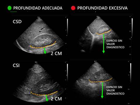 POCUS_ZAC_MC's tweet photo. ✅ Ajusta así: — +2 cm del borde posterior del riñón (CSD/CSI) — +5 cm desde la pared posterior de la vejiga (suprapúbica) — Justo detrás del pericardio posterior (vista SX) — Pleura en el tercio medio de la pantalla (tórax anterior)
#Ultrasound #EFAST https://t.co/7Xjsjks9l4