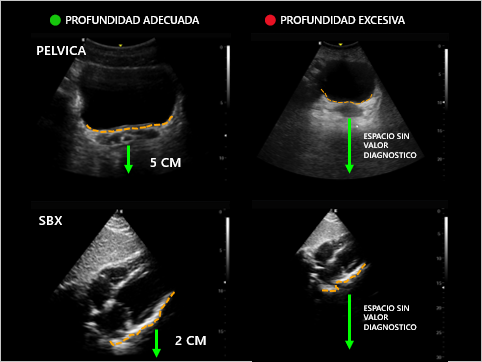 POCUS_ZAC_MC's tweet photo. ✅ Ajusta así: — +2 cm del borde posterior del riñón (CSD/CSI) — +5 cm desde la pared posterior de la vejiga (suprapúbica) — Justo detrás del pericardio posterior (vista SX) — Pleura en el tercio medio de la pantalla (tórax anterior)
#Ultrasound #EFAST https://t.co/7Xjsjks9l4