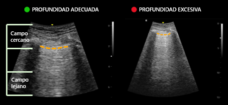 POCUS_ZAC_MC's tweet photo. ✅ Ajusta así: — +2 cm del borde posterior del riñón (CSD/CSI) — +5 cm desde la pared posterior de la vejiga (suprapúbica) — Justo detrás del pericardio posterior (vista SX) — Pleura en el tercio medio de la pantalla (tórax anterior)
#Ultrasound #EFAST https://t.co/7Xjsjks9l4