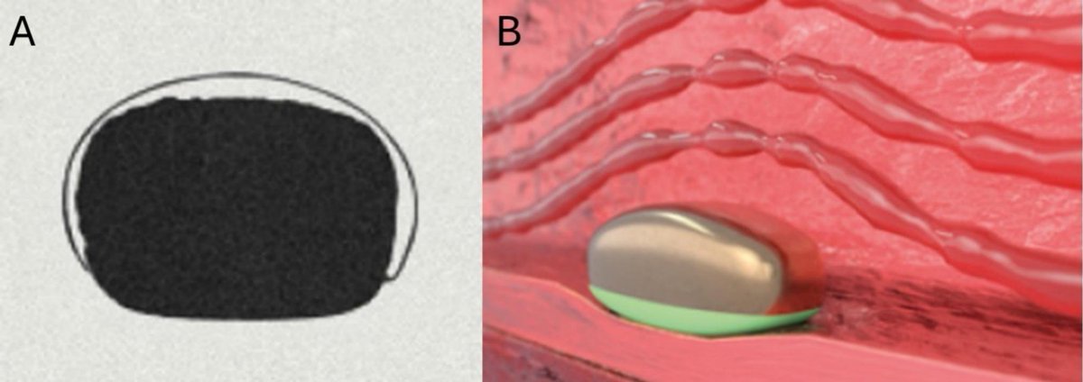 CRMjournal (@crmjournal) on Twitter photo Just accepted in <a href="/CRMjournal/">CRMjournal</a>+@ELS_Cardiology!
Long-term outcomes of hydrodynamic ultra-thin strut sirolimus-eluting #Stent with fluoropolymer containing triflusal: #VELAZQUEZ-EPIC26 study by Jose Antonio Linares Vicente et al.
sciencedirect.com/science/articl… Just accepted in <a href="/CRMjournal/">CRMjournal</a>+@ELS_Cardiology!
Long-term outcomes of hydrodynamic ultra-thin strut sirolimus-eluting #Stent with fluoropolymer containing triflusal: #VELAZQUEZ-EPIC26 study by Jose Antonio Linares Vicente et al.
sciencedirect.com/science/articl…