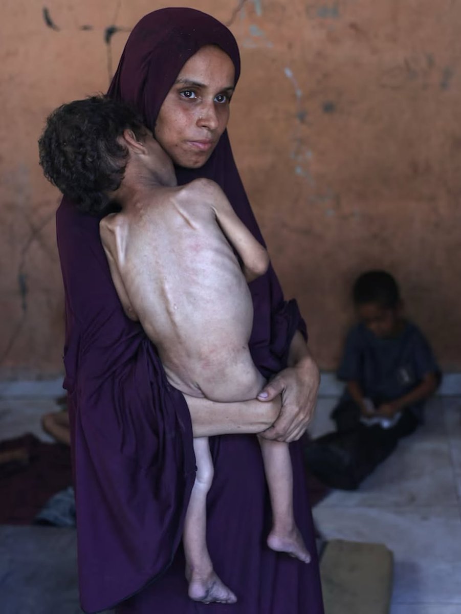 "تحول جسد هذا الطفل إلى هيكل عظمي، ليس بفعل الزمن، بل بفعل الجوع الذي حاصره في غزة... جوعٌ سرق منه الطفولة، واللحم، وحتى الحلم."