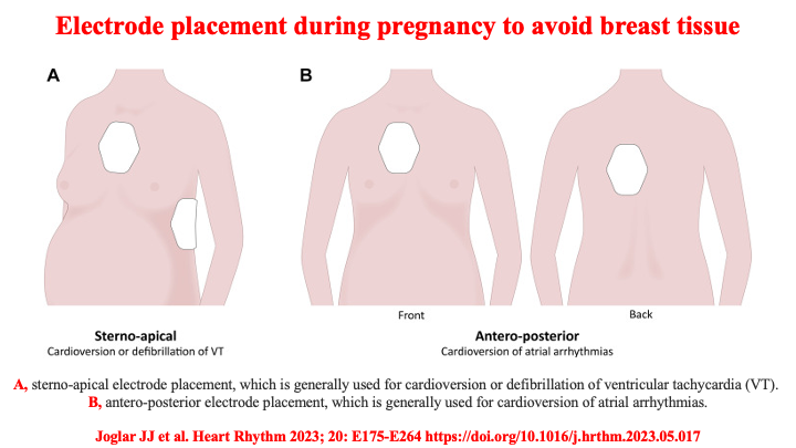 drraviele's tweet image. 📌 Figure illustrating
👉 Optimal electrode placement for #cardioversion during #pregnancy to avoid breast tissue
#EPeeps #WomeninEP #CardioTwitter #MedTwitter #Obstretics @MargaridaPujol @KTamirisaMD @DrMarthaGulati @AnastasiaSMihai @Hragy @iamritu @ShelleyZieroth @yolyabreuh