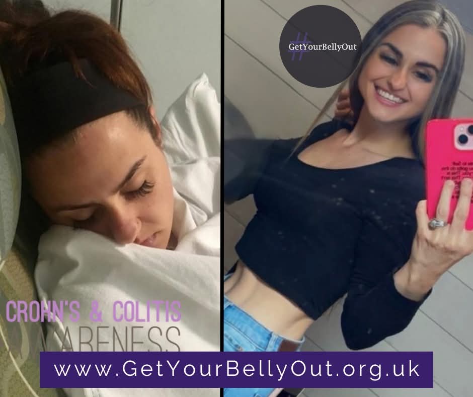 GetYourBellyOut's tweet image. My #GetYourBellyOut story: Stephanie
My name is Stephanie, I live in Rhode Island, and eight years ago I was diagnosed with Crohn’s Disease. 
On January 3, 2016, I met with a Doctor who carefully went over my medical records and sent me for a colonoscopy. My results came back