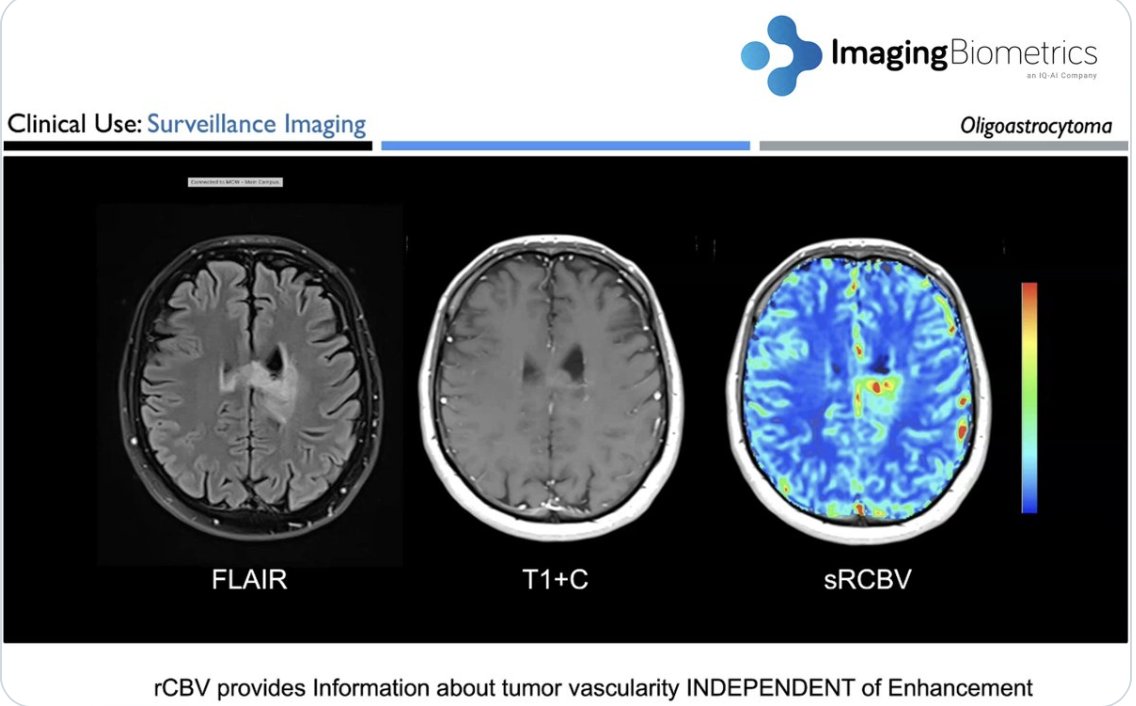 Nearly 50 % of radiologists report burnout—IB Neuro’s automated tools streamline analysis, enhance efficiency, reduce errors, alleviate workload stress, and improve radiologist experience! #Radiology #BurnoutPrevention #AIinHealthcare
