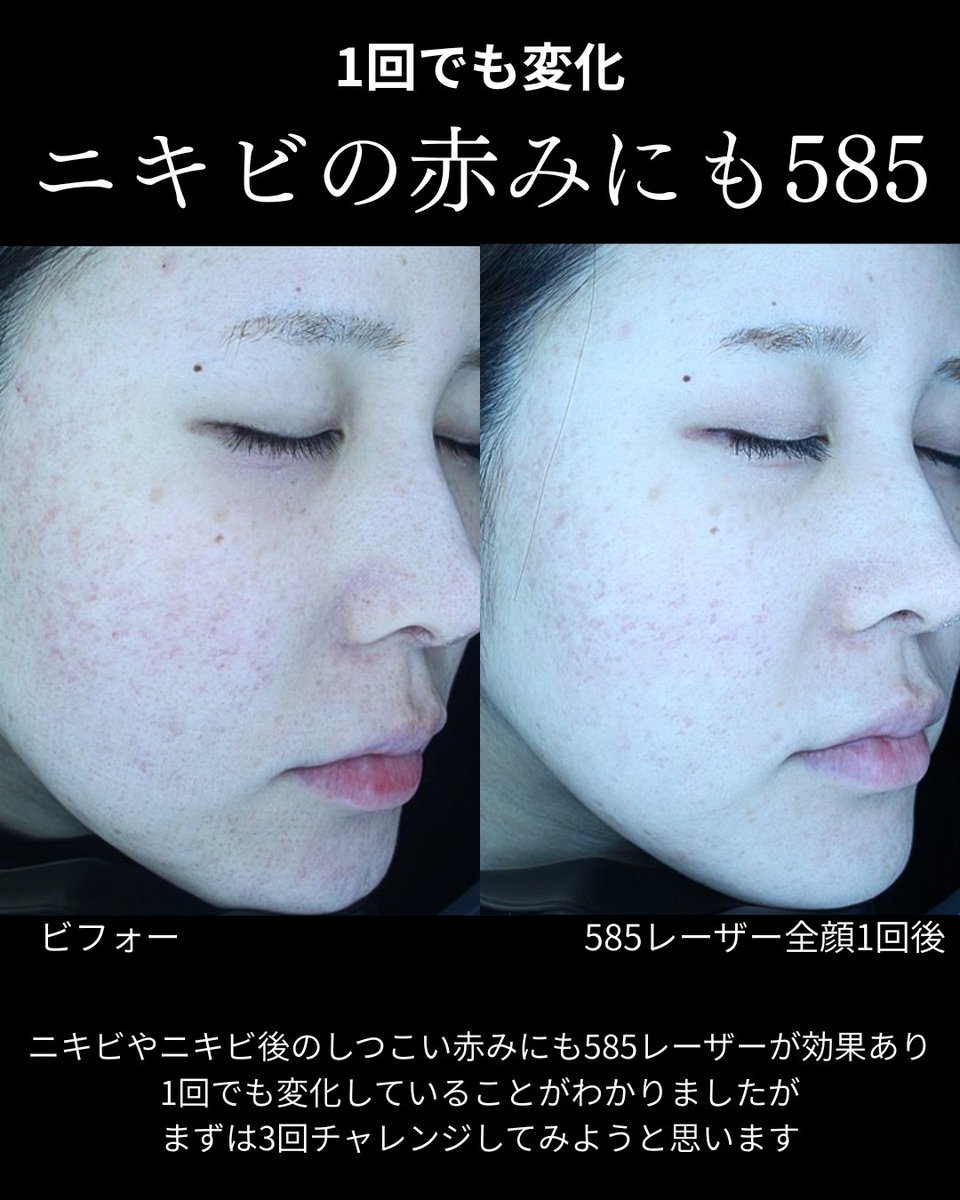 にきび痕の赤みにも585はきく。