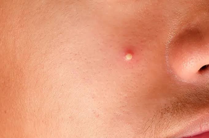 fiblms's tweet image. ngilangin jerawat ini tuh gimana sih guys? numbuh terus cape, mana udahnya jadi berbekas lagi