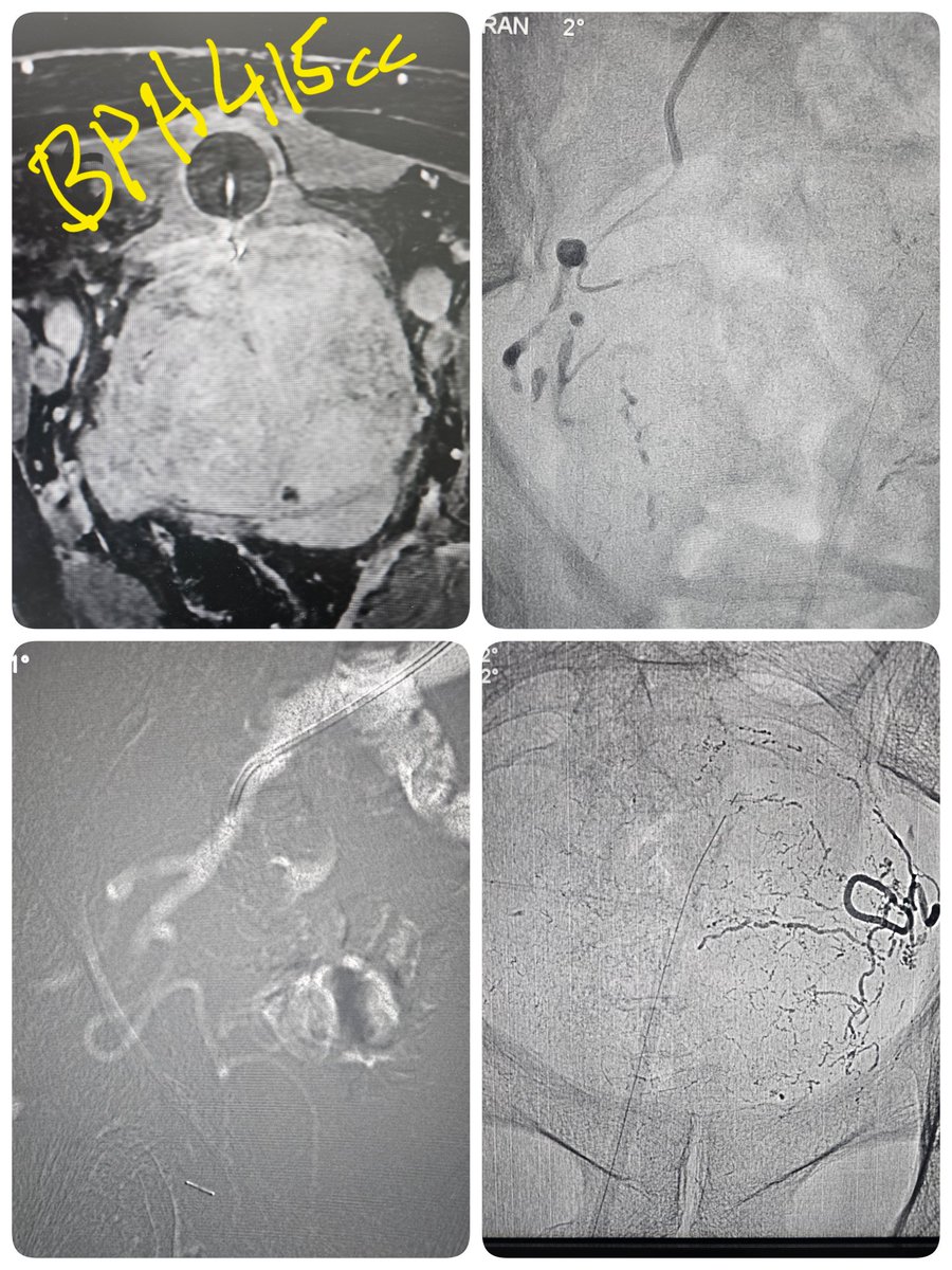 د.محمد المعيقل (@mohmadalmoaiql) on Twitter photo Co2 PAE Glue , only 10 cc Visipaque, BPH recurrence post laser
علاج تضخم البروستاتا بإغلاقها بالصمغ بإستخدام غاز ثاني أكسيد الكربون لإرتفاع
وظائف الكلى وتقليل كمية الصبغه
<a href="/Dawaliclinic1/">مركز عيادات دوالي 🥼</a> <a href="/bentawalah/">د محمد الطواله Altwalah</a> Co2 PAE Glue , only 10 cc Visipaque, BPH recurrence post laser
علاج تضخم البروستاتا بإغلاقها بالصمغ بإستخدام غاز ثاني أكسيد الكربون لإرتفاع
وظائف الكلى وتقليل كمية الصبغه
<a href="/Dawaliclinic1/">مركز عيادات دوالي 🥼</a> <a href="/bentawalah/">د محمد الطواله Altwalah</a>