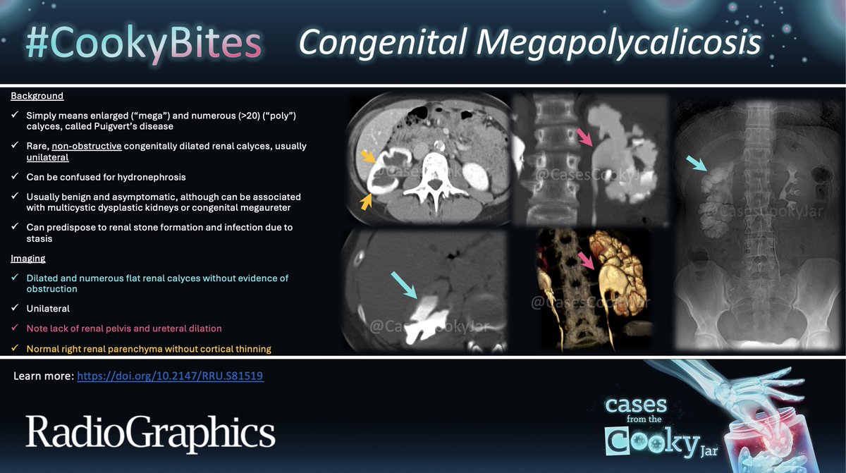 Cases From the Cooky Jar (@casescookyjar) on Twitter photo Answer: Congenital Megapolycalicosis
Learn more:
doi.org/10.2147/RRU.S8…
#CookyBites #225 #RGphx <a href="/cookyscan1/">Cooky Menias</a> <a href="/RadioGraphics/">RadioGraphics</a> Answer: Congenital Megapolycalicosis
Learn more:
doi.org/10.2147/RRU.S8…
#CookyBites #225 #RGphx <a href="/cookyscan1/">Cooky Menias</a> <a href="/RadioGraphics/">RadioGraphics</a>