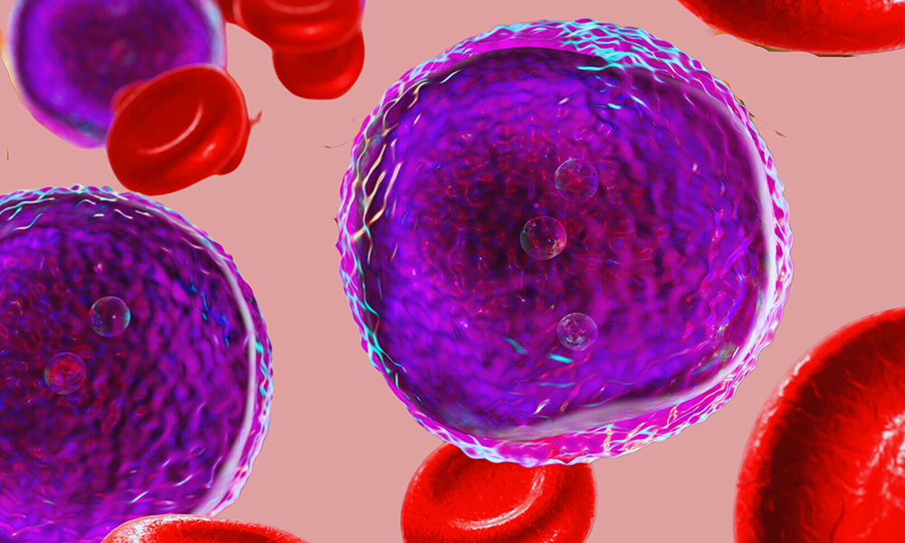 New data 📝 A pooled analysis of three studies, presented by Elias Jabbour at #EHA2025, demonstrated improved PFS and OS outcomes with ≤3.3 mg/m2 vs &gt;3.3 mg/m2 inotuzumab ozogamicin in patients with R/R B-ALL.

Learn more: loom.ly/Tr0m1yw

#ALLsm #leusm #MedNews #MedEd