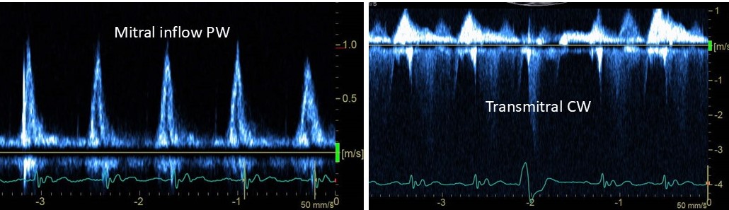 An elderly patient with known severe left ventricular dysfunction is admitted with hypotension. Annular tissue Doppler velocities are low. What are the likely left ventricular filling pressures?