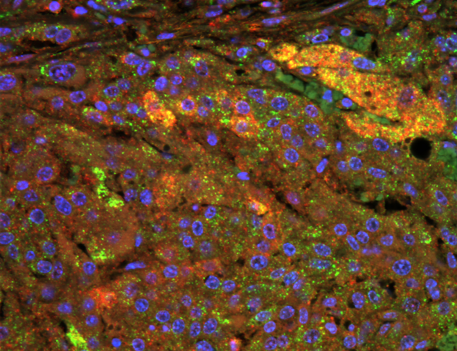 Science Translational Medicine (@sciencetm) on Twitter photo Scientists discover that the protein AGPAT4 is heavily involved in #HCC tumor metabolism, plasticity, and resistance to #sorafenib, and discover an AGPAT4 inhibitor that can sensitize tumors to treatment in mice. <a href="/stephaniema912/">Stephanie Ma</a> <a href="/hkumed/">HKU Medicine</a>
scim.ag/4l6etXy Scientists discover that the protein AGPAT4 is heavily involved in #HCC tumor metabolism, plasticity, and resistance to #sorafenib, and discover an AGPAT4 inhibitor that can sensitize tumors to treatment in mice. <a href="/stephaniema912/">Stephanie Ma</a> <a href="/hkumed/">HKU Medicine</a>
scim.ag/4l6etXy