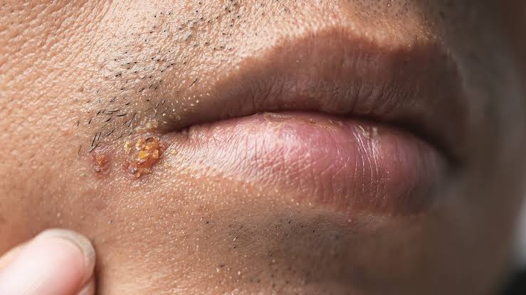 I'm seeing a lot of people say Malaria. This is not Malaria!!!

This is an infection caused by a Virus called Herpes simplex virus( HSV).

Why do most people attribute it to malaria?

A lot of times when people have the virus and it causes those things on the lips called