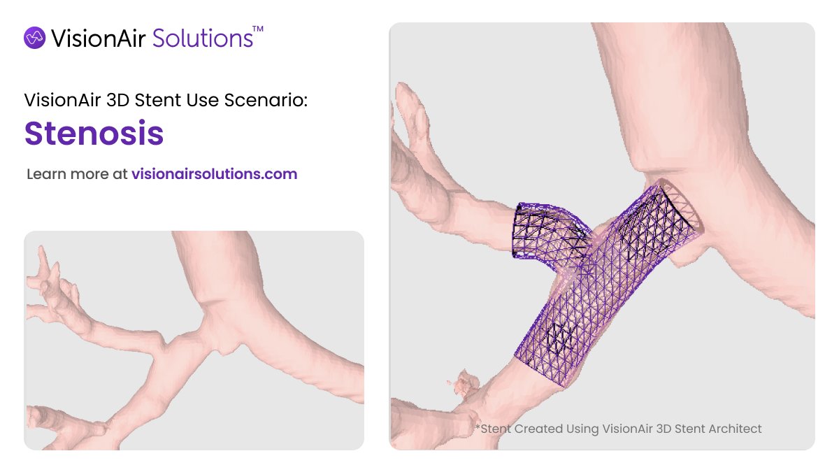 #TransplantTuesday

📄 Case: Post-lung transplant with stenotic right main stem.

❓ Challenge: An irregular airway branch angle and airway instability requiring personalized intervention.

✅ Solution: A contoured patient-specific stent designed using V3D software to conform to