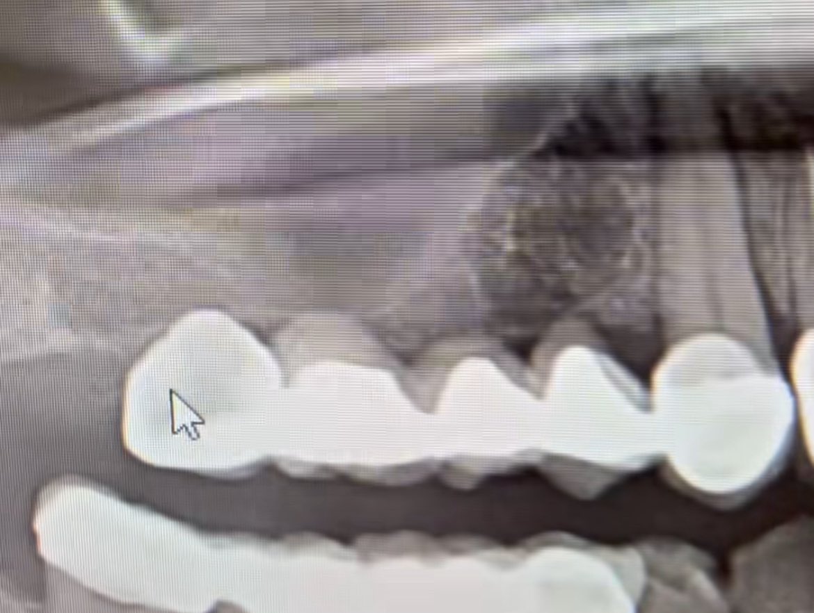 İmplant istemeyen hastanın sorunsuz kronları