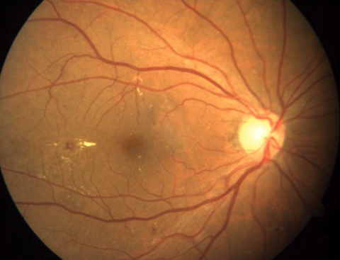 Diabetic Retinopathy Screening May Help Identify Early Cardiovascular Disease

The association was noted even in mild cases. Read the story: reviewofoptometry.com/article/diabet…
#diabetes #retina #diabeticretinopathy #optometry
