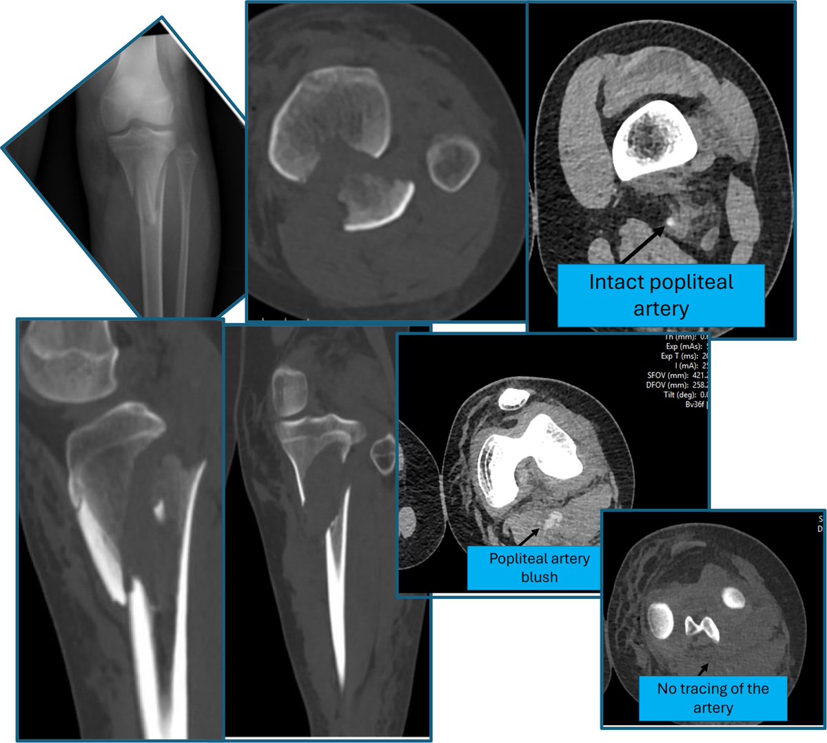 Proximal tibial fracture in adolescent can be associated with popliteal artery injury. Neurovascular exam of the affected extremity is of utmost importance. If popliteal artery injury is present, urgent ExFix, fasciotomy and vascular repair should be done.