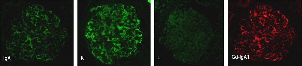 shary_tang's tweet photo. 68yrs, male, NS. LM: MN pattern; IF: IgAK+; GdIgA1+; EM: subepithelial fibrils. No MIg detected. Cryo (weak+). FGN? PGNMID? CryoGN? #renalpath #askrenalpath https://t.co/8KJrxk4ZfK