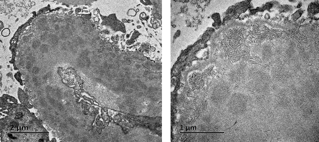 shary_tang's tweet photo. 68yrs, male, NS. LM: MN pattern; IF: IgAK+; GdIgA1+; EM: subepithelial fibrils. No MIg detected. Cryo (weak+). FGN? PGNMID? CryoGN? #renalpath #askrenalpath https://t.co/8KJrxk4ZfK