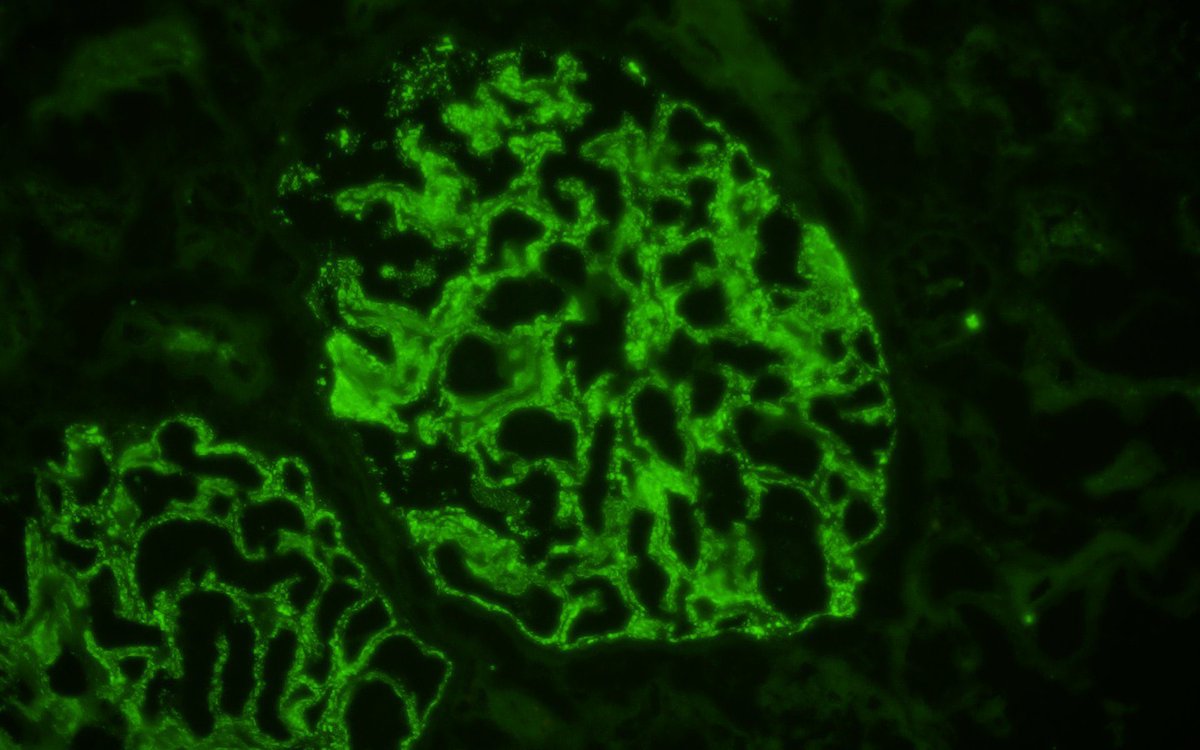 Zhou1217001's tweet photo. #askrenalpath young female, NS, normal Scr, membranous pattern on LM. subepithelial EDD with spherules on EM. IgA was 3+, while IgG was trace(shown as follows). K and 入both positive, C1q was negative. No secondary factors was found. Serum complement was normal. Any thoughts? https://t.co/OaoJbR0TXo