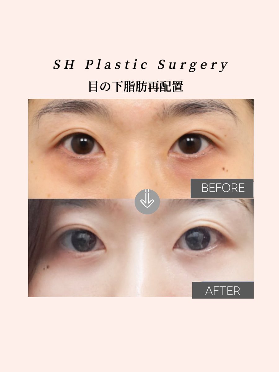 kshclinic's tweet image. ✿─────────────✿                         
　　　　
　　        目の下の重要性✍️

               ✔️クマの改善
            ✔️疲れ顔の解消 
      ✔️お顔全体のトーンアップ
             ✔️若返り効果
✿─────────────✿  

#目の下脂肪再配置 #涙袋 #目の下のクマ