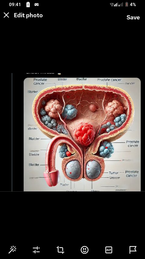Kubasore Gusa
                            ,ese Gukora sex cne bishobora Gutera cancer ya prostate  cg ni binyoma?

Reka tubirebe musi  👇
Thread 🧵