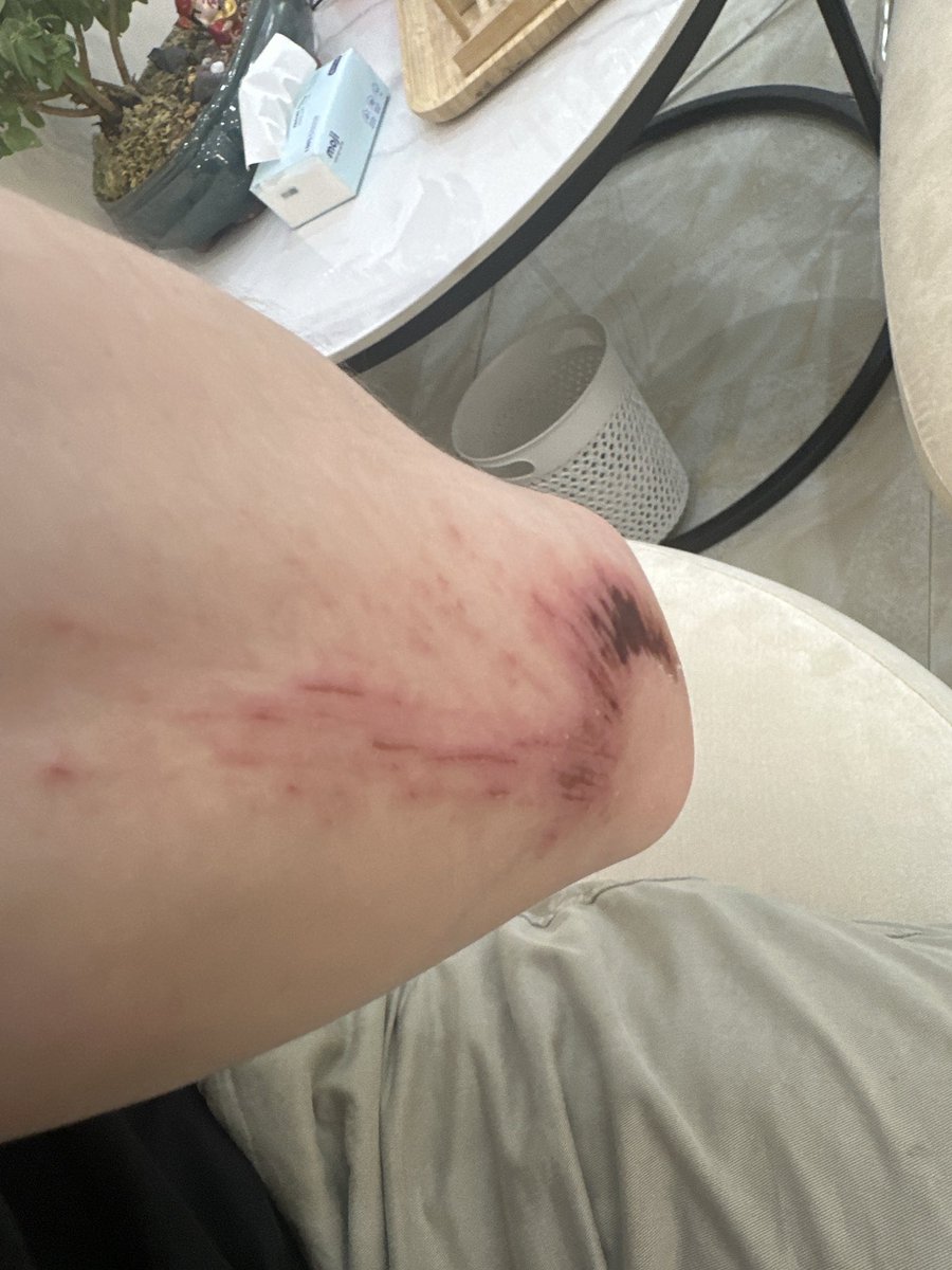 rubi (@t9ruby) on Twitter photo It’s been a long time since I played football. Had a blast playing w the nads ya’ll played well. Special thanks to <a href="/Kan210696/">Kan Moyaking ⨀</a> for the bruise 😉.
GG <a href="/vietnads/">Vietnads 🇻🇳 ⨀</a> <a href="/koreanads/">Koreanads 🇰🇷 (evm/acc) ⨀</a> It’s been a long time since I played football. Had a blast playing w the nads ya’ll played well. Special thanks to <a href="/Kan210696/">Kan Moyaking ⨀</a> for the bruise 😉.
GG <a href="/vietnads/">Vietnads 🇻🇳 ⨀</a> <a href="/koreanads/">Koreanads 🇰🇷 (evm/acc) ⨀</a>