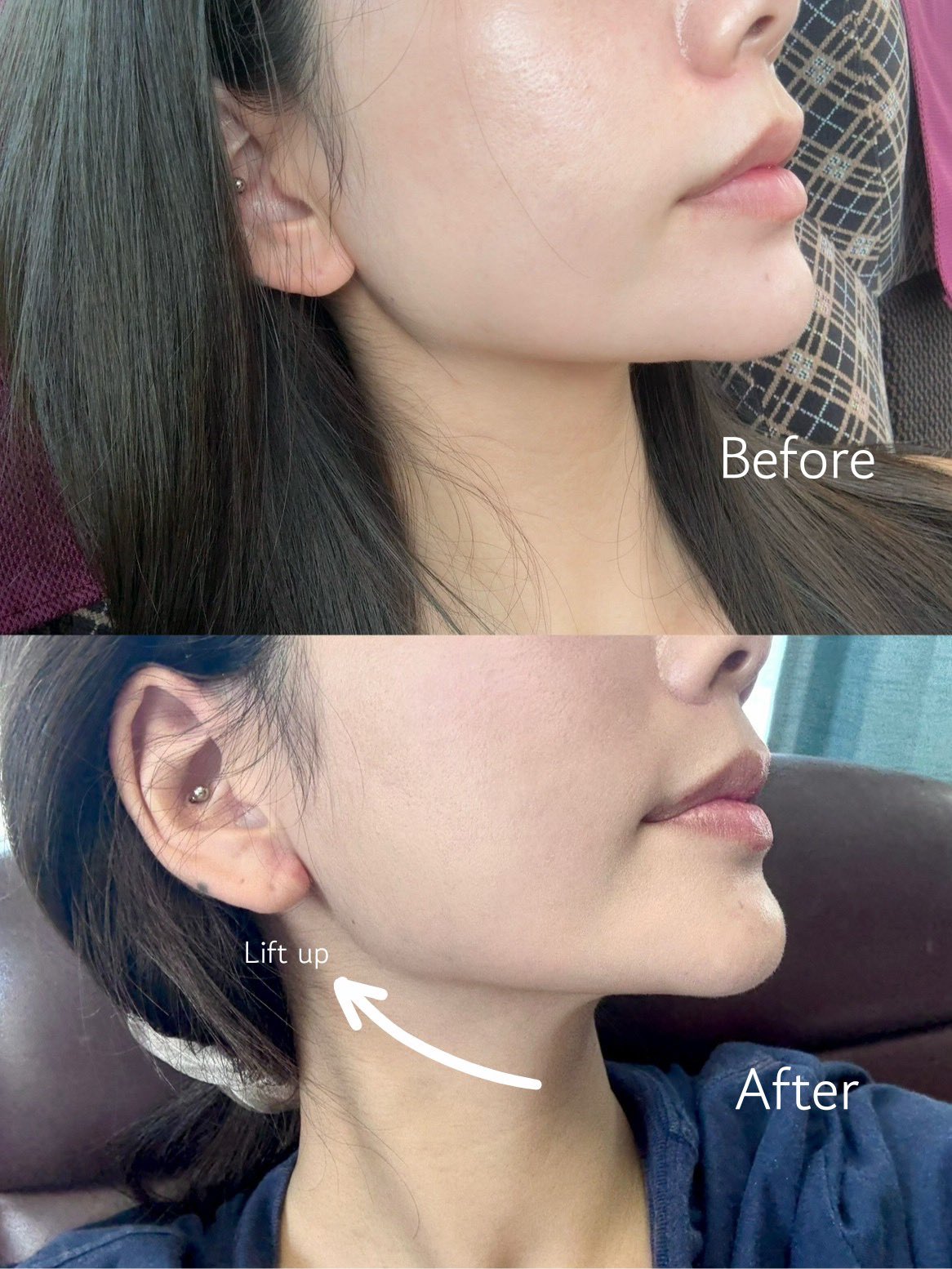 Torriden プランエスクリニック【強】 プランエスクリニック