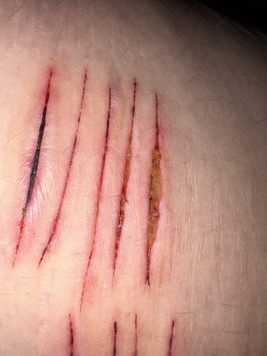 tw; healing cuts 
guys… r these infected like frfr to the point i need to worry