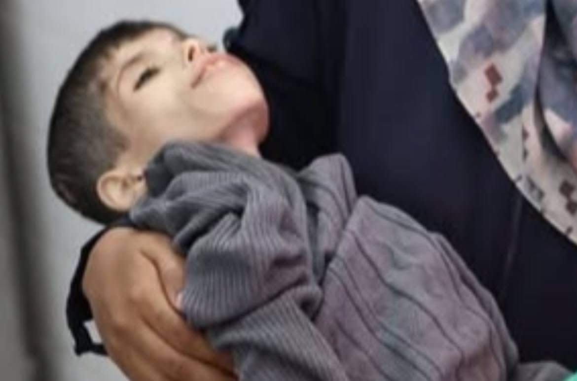 Tamer Shuhiber, a child, died from malnutrition caused by the ongoing total blockade that Israel has enforced on Gaza for more than 150 days.