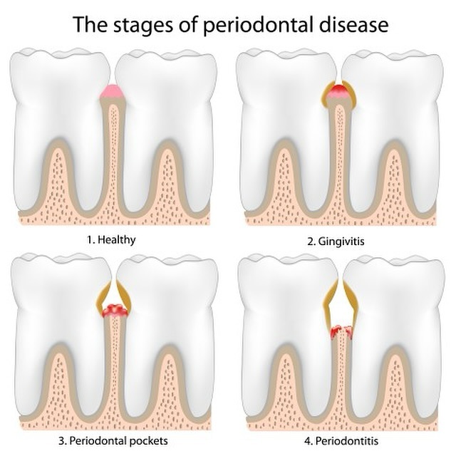 The stages of periodontal disease📚